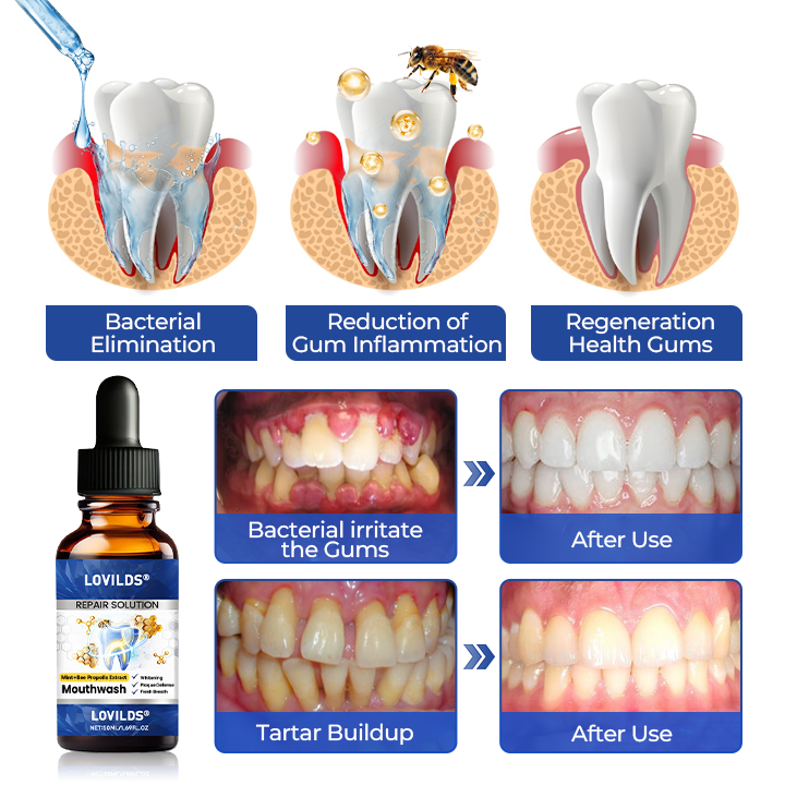 Buy 3 get 3 free🏅🦷🛡️ LOVILDS Bee Propolis Extract Oral Repair Solution