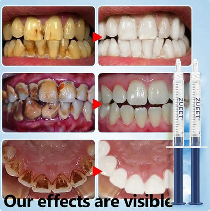 𝙕𝙐𝙀𝙀𝙏® BMP-2 x TGF-β (Stem Cell Support) Whitening, Regenerating, and Repairing Dental Gel - Results in 7 days💎